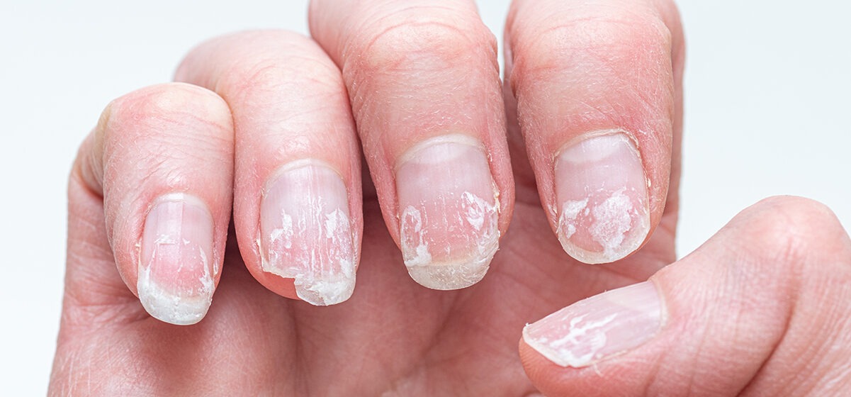 HT6. Rippled fingernails reveal secrets of possible disease