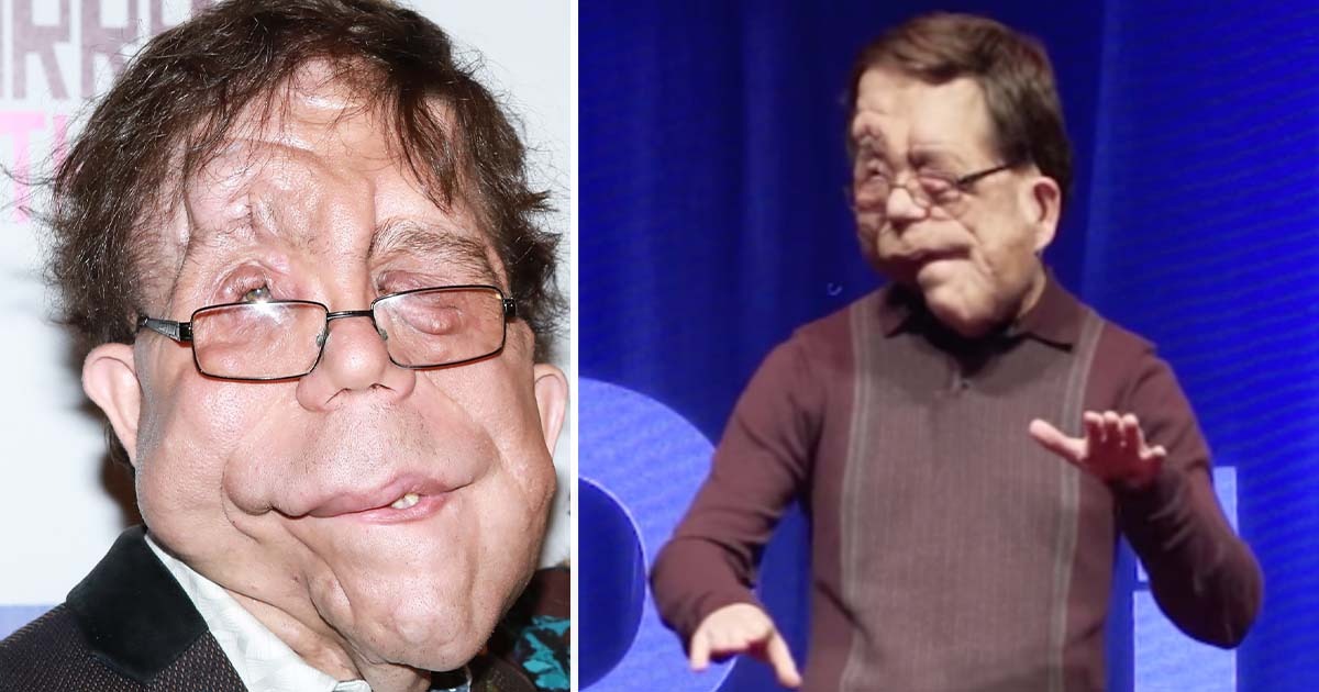 HT6. The extraordinary life of Adam Pearson: The actor with a genetic disorder didn’t let anyone stand in his way