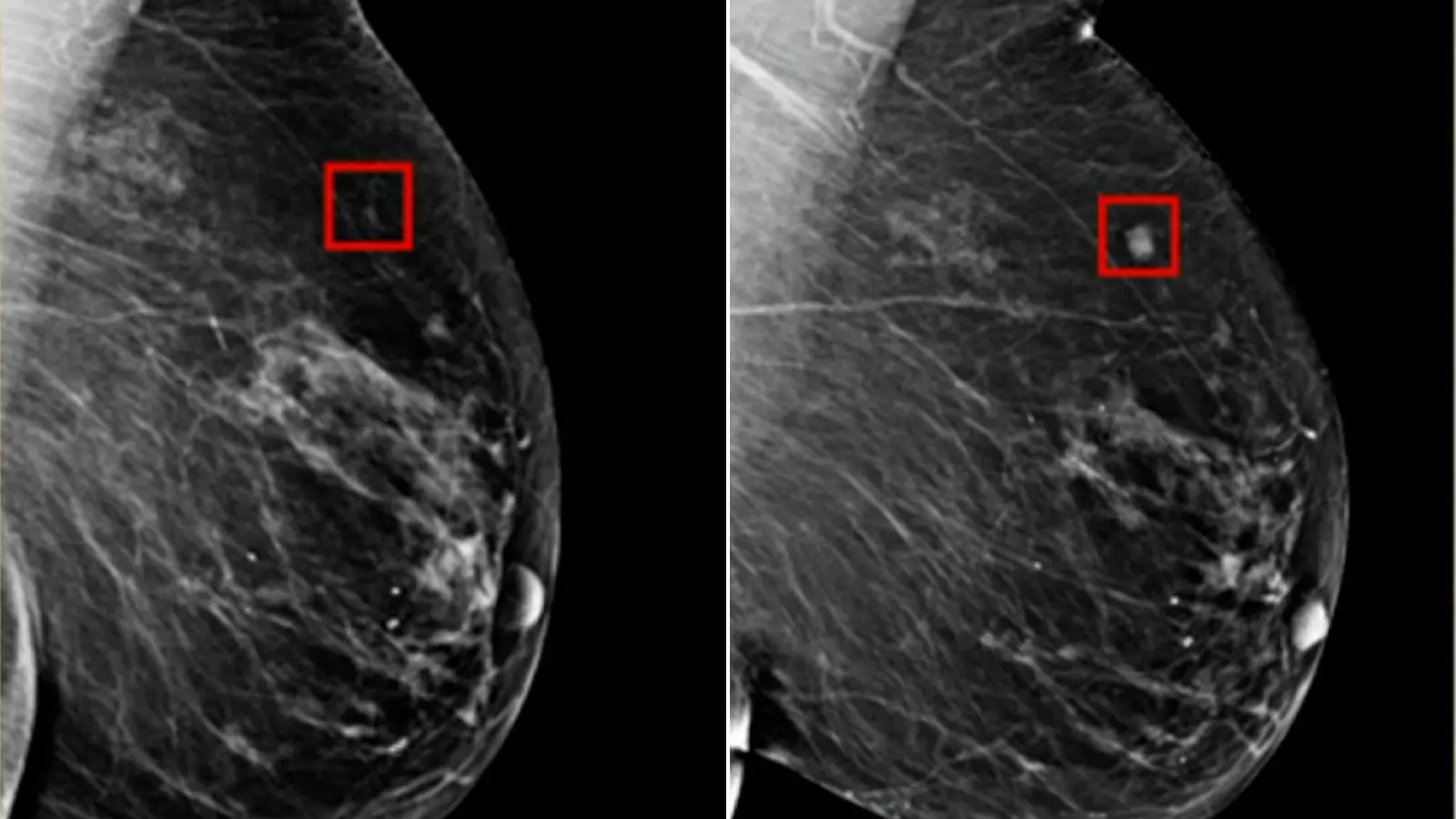 HT6. A new type of Artificial Intelligence can detect breast cancer 5 years before diagnosis
