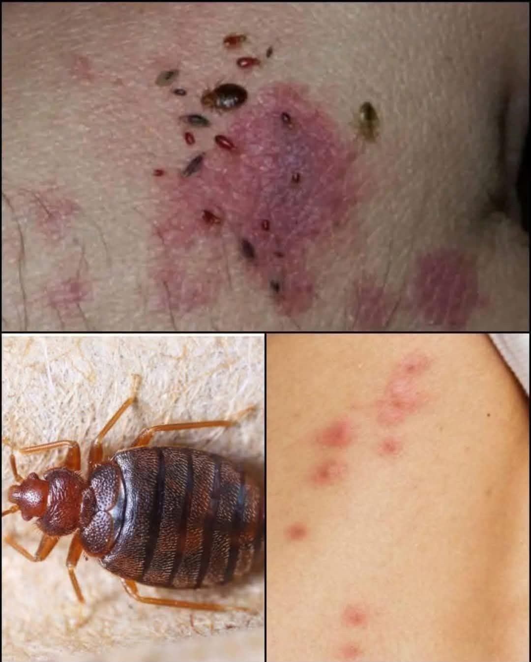 HT6. Doctor Explains Scabies Skin Rash: Symptoms, Photos, Treatment, and More