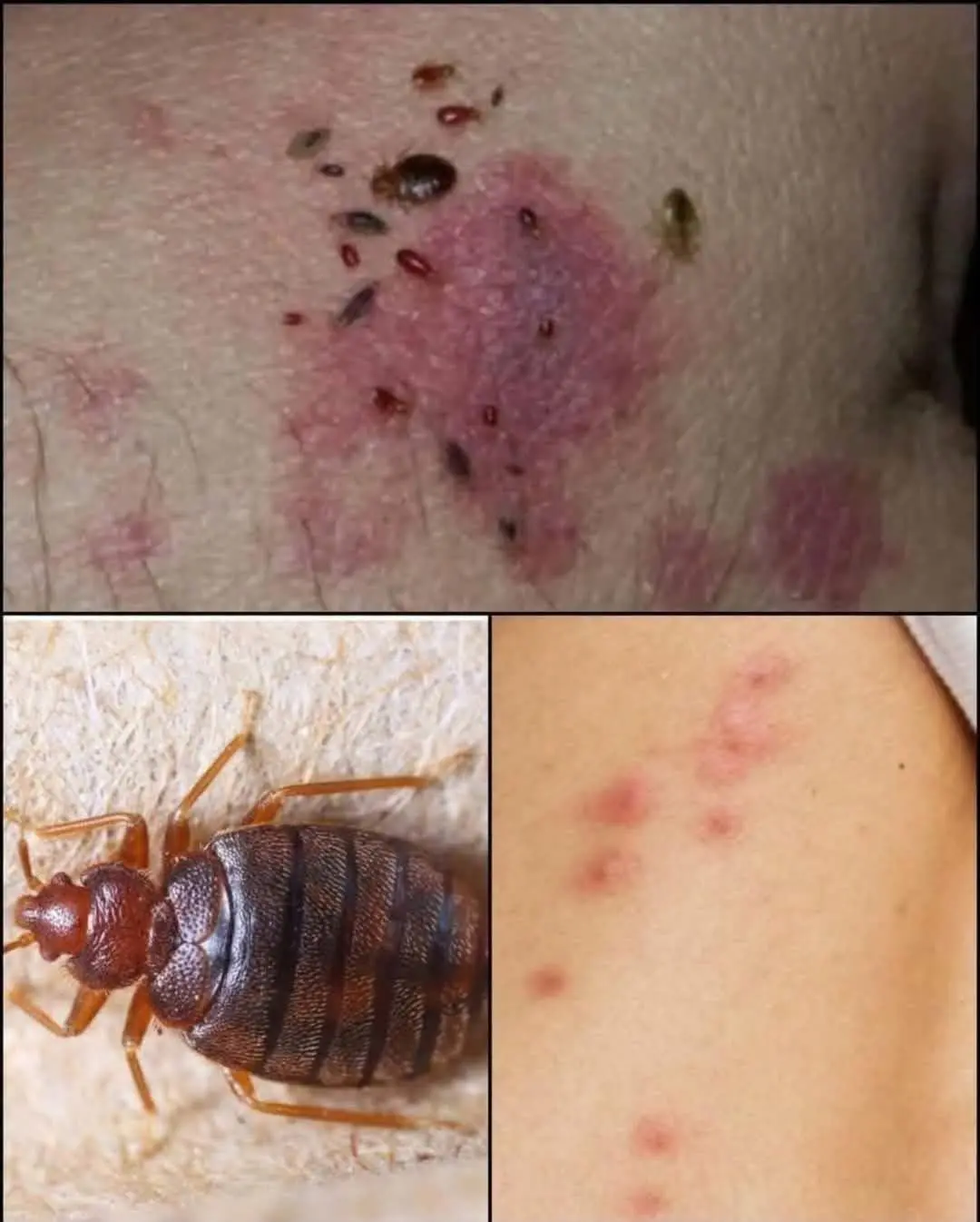 HT6. Doctor Explains Scabies Skin Rash: Symptoms, Photos, Treatment, and More