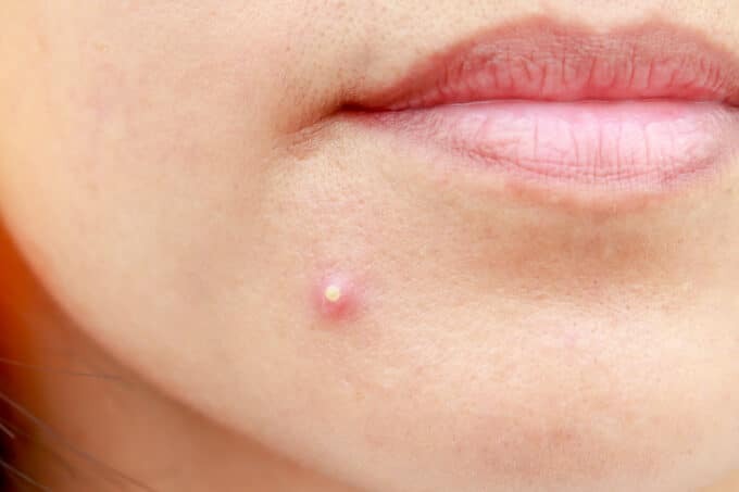 ST6. Dangerous Types of Pimples You Should Never Pop: A Guide to Healthy Skin Care