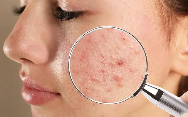 ST6. Dangerous Pimples on Your Skin You Should Never Pop: Here’s Why