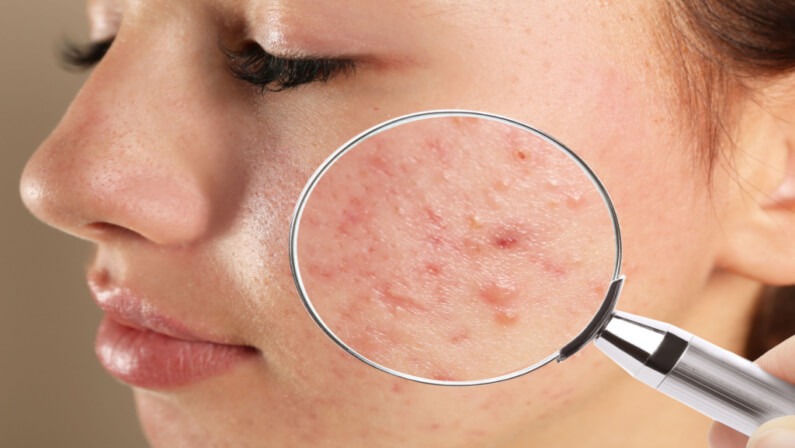 ST6. 5 Dangerous Pimples You Should Never Squeeze