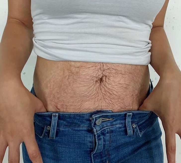 ST6. Woman Shows the Raw Truth of Postpartum Bodies
