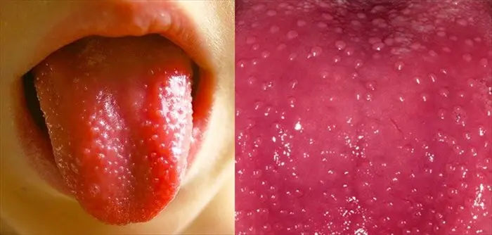 HT6. 8 Things That Your Tongue Tell You About Your Health…