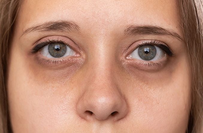 HT6. The Frightening Truth About Under-Eye Packs and Dark Circles: The Most Perilous Causes
