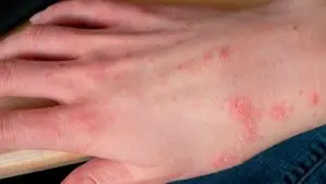 HT6. Understanding Scabies