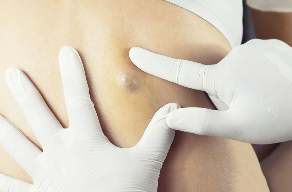 ST6. Understanding Skin Cysts: Causes, Treatments, and Medical Advice from Dermatologists