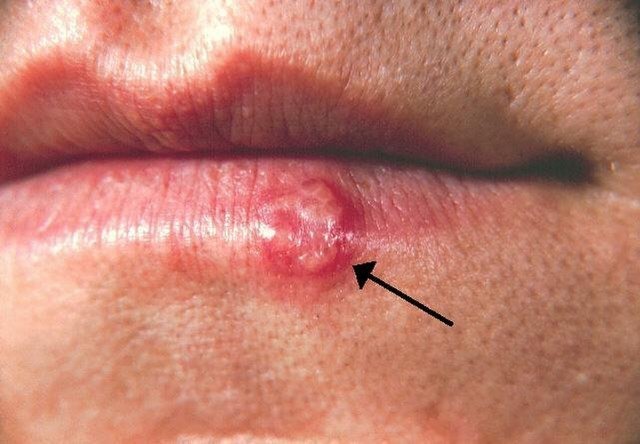 HT6. Most People Have Had or Have This Cold Sore Virus, But Very Few Know How to Cure It – Here’s What You Need to Do!