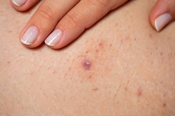 HT6. All the Symptoms of Stomach Cancer