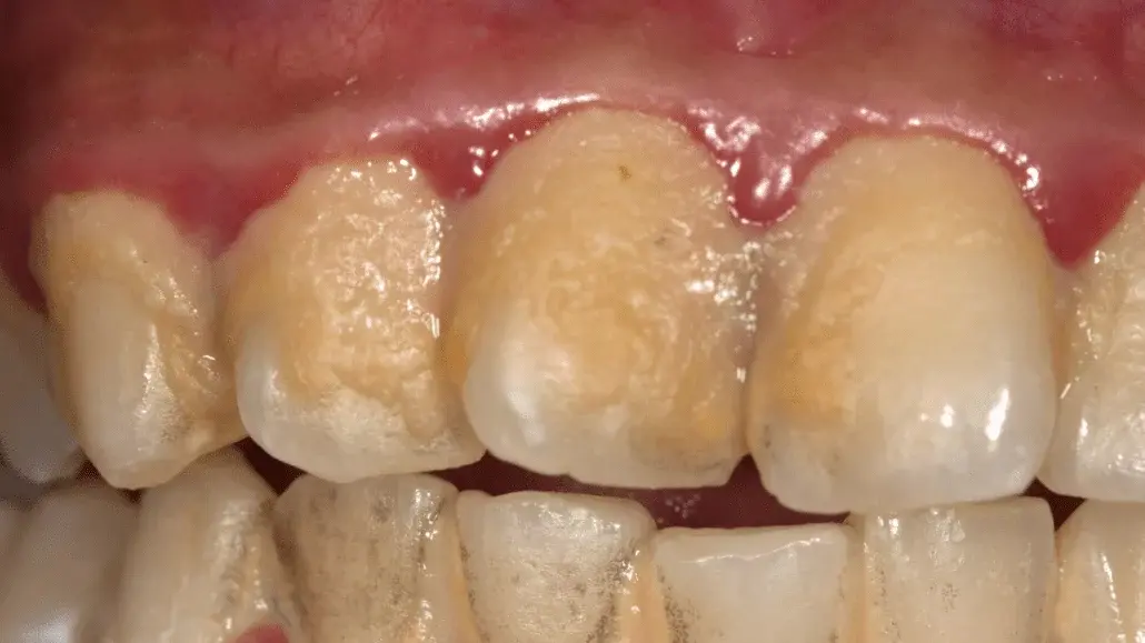 HT6. Be careful!! This is what your teeth will become when you eat…
