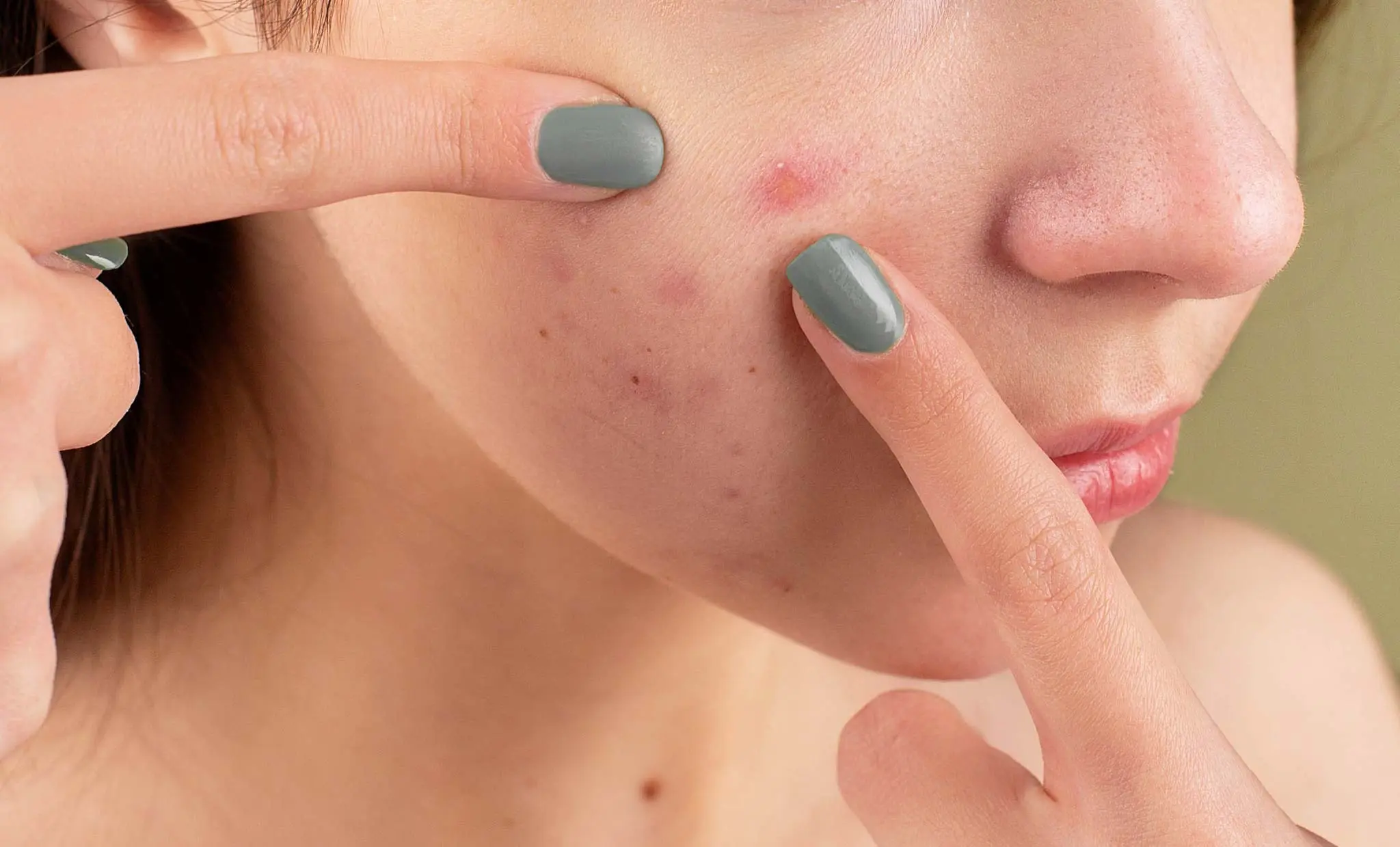 ST6. Experience a Soothing and Informative Journey When You Watch ‘Relax with Squeeze Acne’