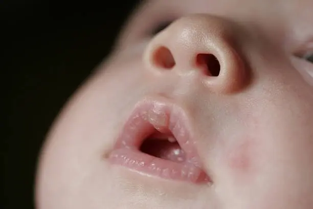 HT6. If your baby has these marks it means… See more