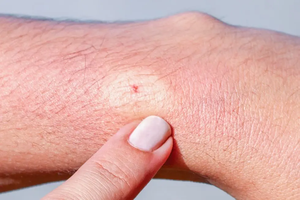 ST6. Understanding Severe Swelling from Bee Stings: Causes, Symptoms, Treatment, and Prevention