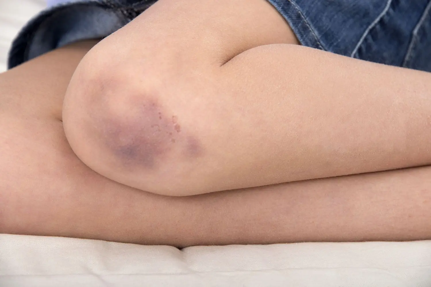 HT6. Little Girl’s Bruises Kept Getting Worse. When Mom Found Out The Truth, It Was Too Late…