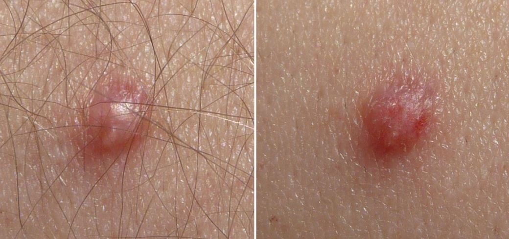 HT6. Signs of Human Papillomavirus You Should Know