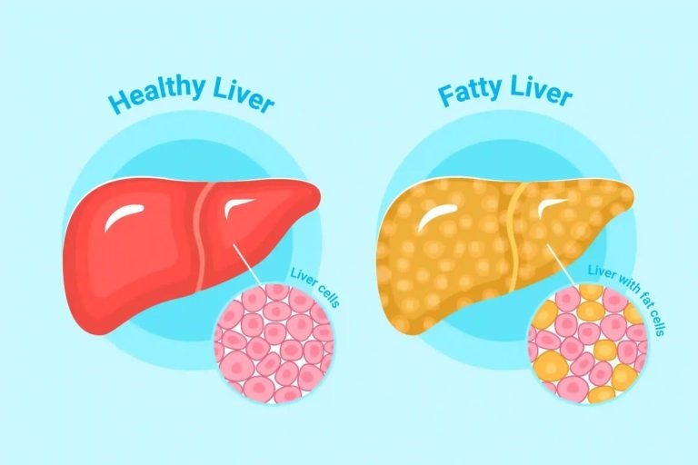 HT6. CLEANSES FATTY LIVER