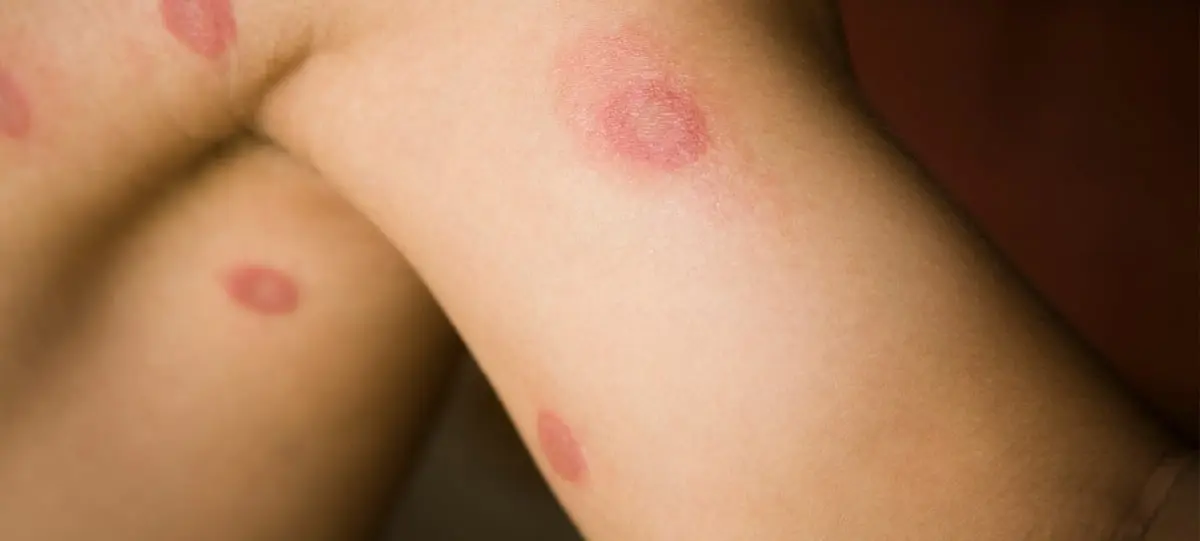 HT6. Ringworm (Tinea Corporis): Causes, Symptoms, Treatment, and Prevention
