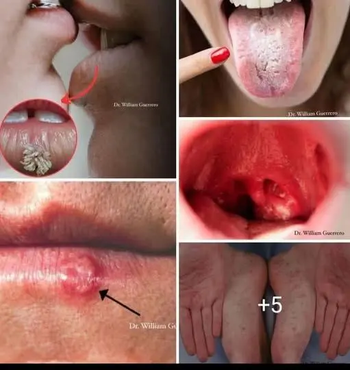 HT6. Don’t Underestimate It: Recognizing the Early Signs of Oral Can…
