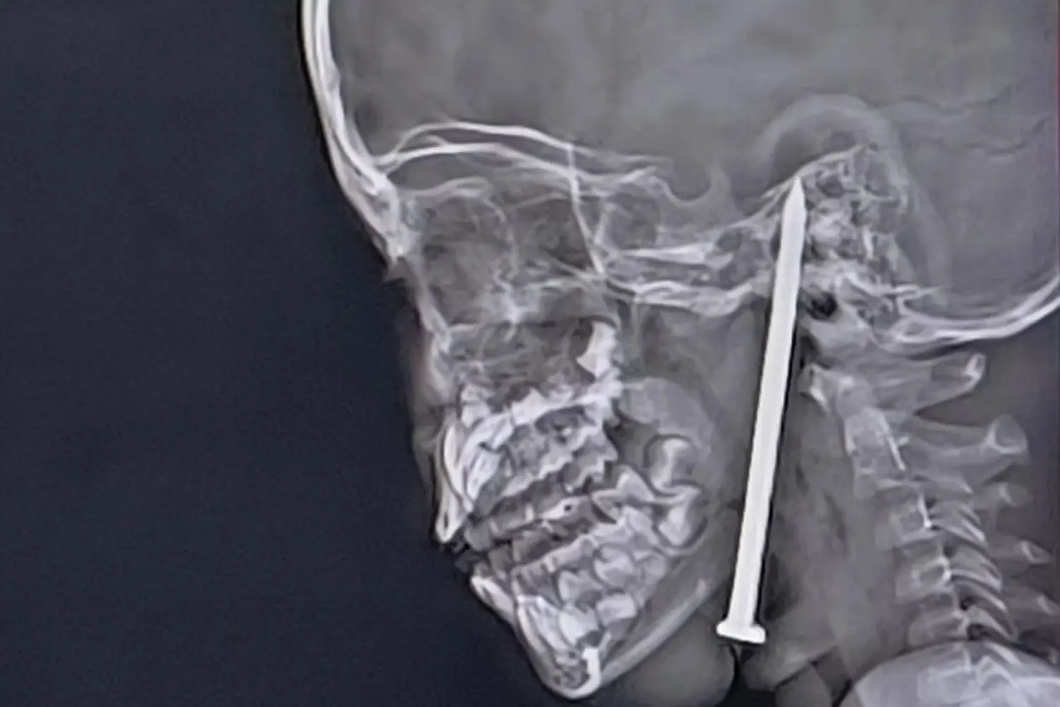 HT6. 7-Year-Old Boy Gets 3-Inch Nail Lodged in His Brain in Freak Accident While Playing