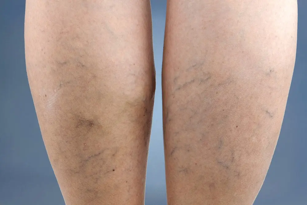 HT6. If you see these points on your feet, it means you have…