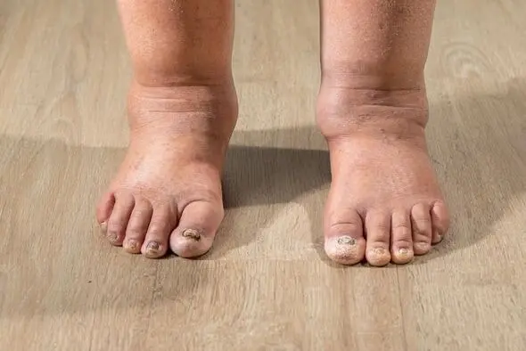 HT6. Health Warning Signs on Your Feet You Should Never Ignore