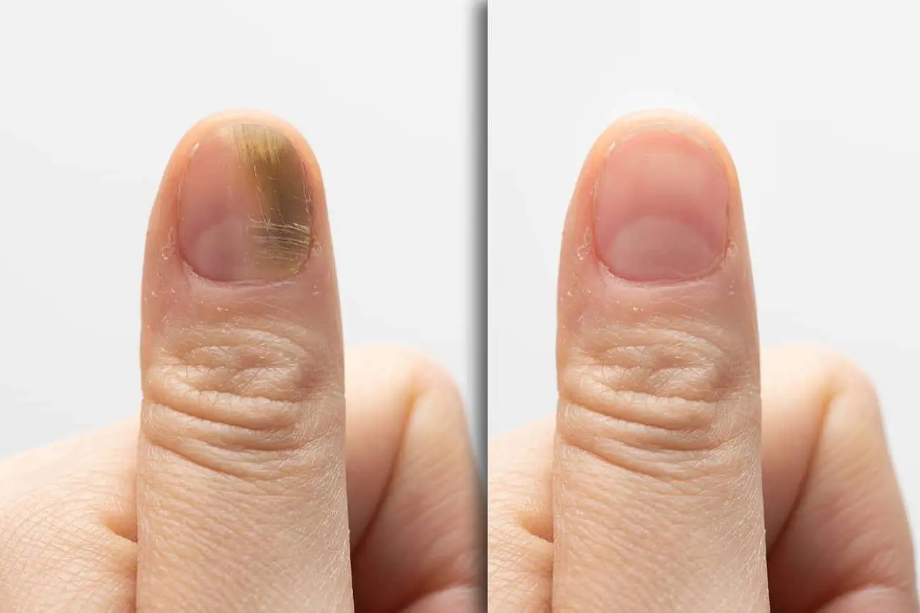 ST6. Fungal Nail Infection: Causes, Symptoms, and Effective Treatments
