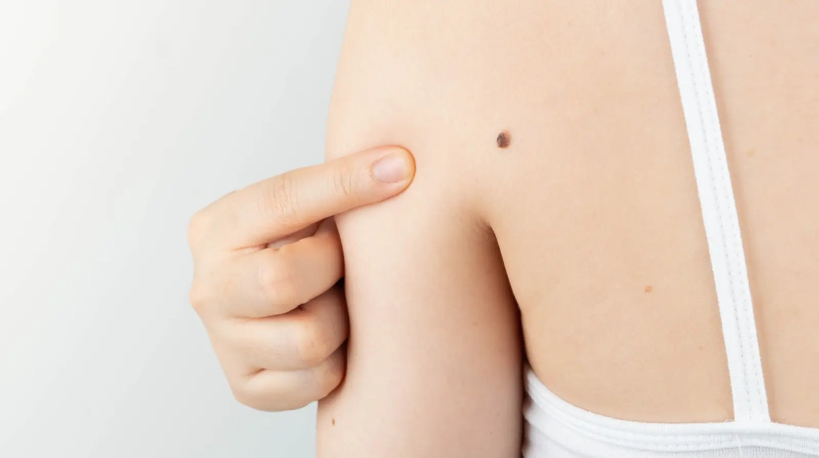 HT6. She Thought It Was Just a Mole… 77 Stitches Later, Doctors Told Her the Truth….