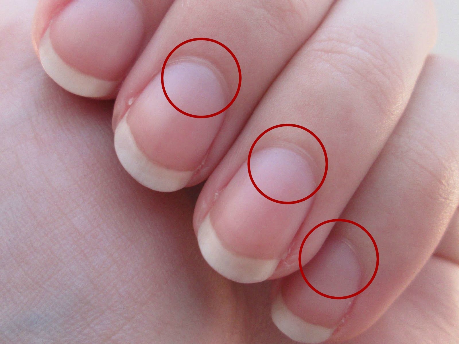 SK. Rippled fingernails reveal secrets of possible disease