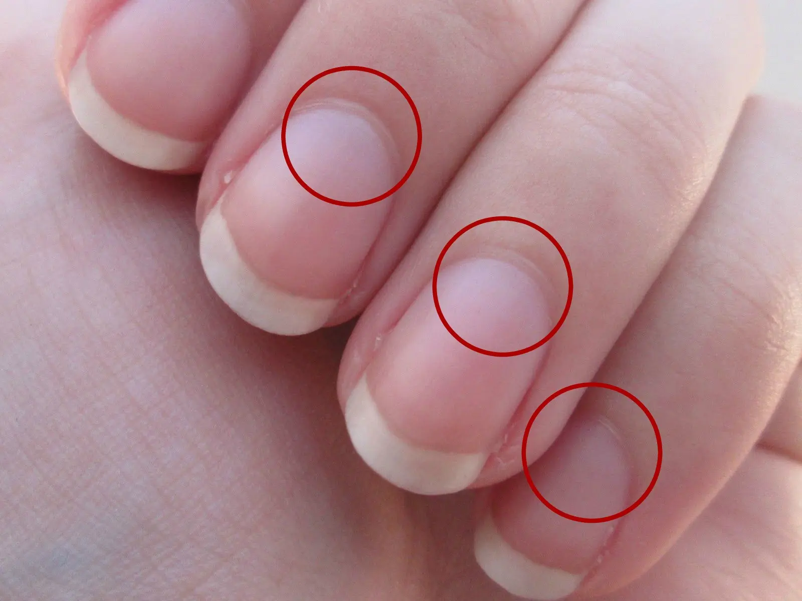 SK. Rippled fingernails reveal secrets of possible disease