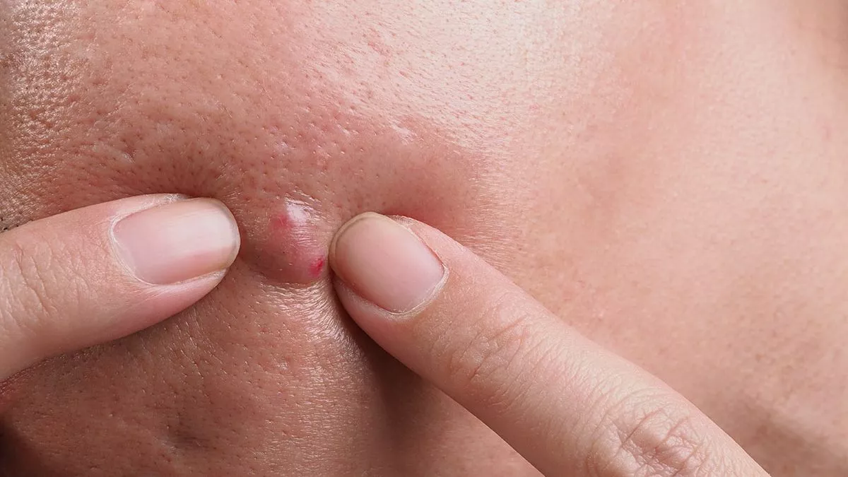 NEWS. Painful Bump on Your Face? The Truth May Surprise You