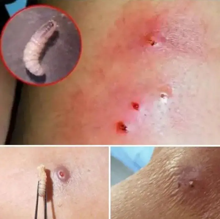 HT6. Larvae Found in Young Woman’s Body… How Did They Get There? (The Answer Will Horrify You)
