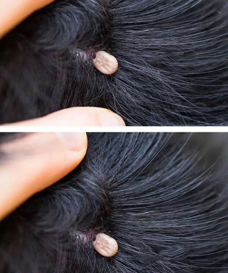 HT6. Just discovered this in my son’s hair. What is it? Not sure if we should go to doc