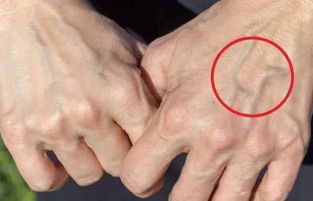 HT6. If you see someone with bulging veins, you must tell them these things…