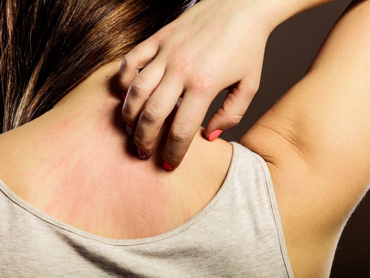 HT6. When Skin Irritations May Point to Something More