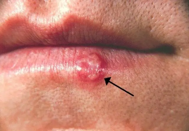 HT6. Most People Have Had or Have This Cold Sore Virus, But Very Few Know How to Cure It – Here’s What You Need to Do!