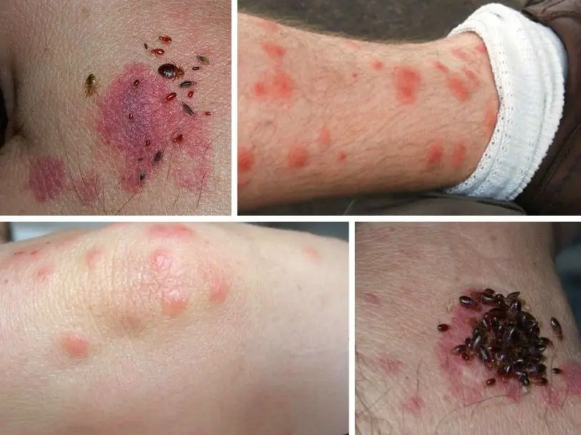 HT6. BE CAREFUL if you get these bruises on your body, it means you have Ca…