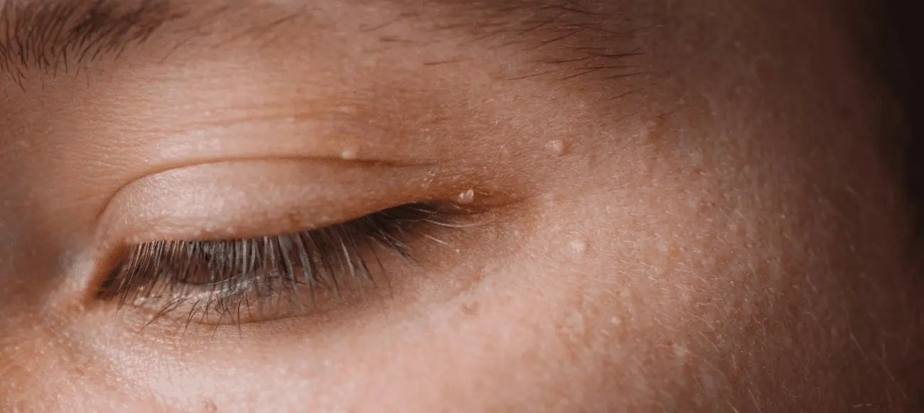 HT6. When White Bumps Appear on Your Skin, What Is Your Body Trying to Tell You?