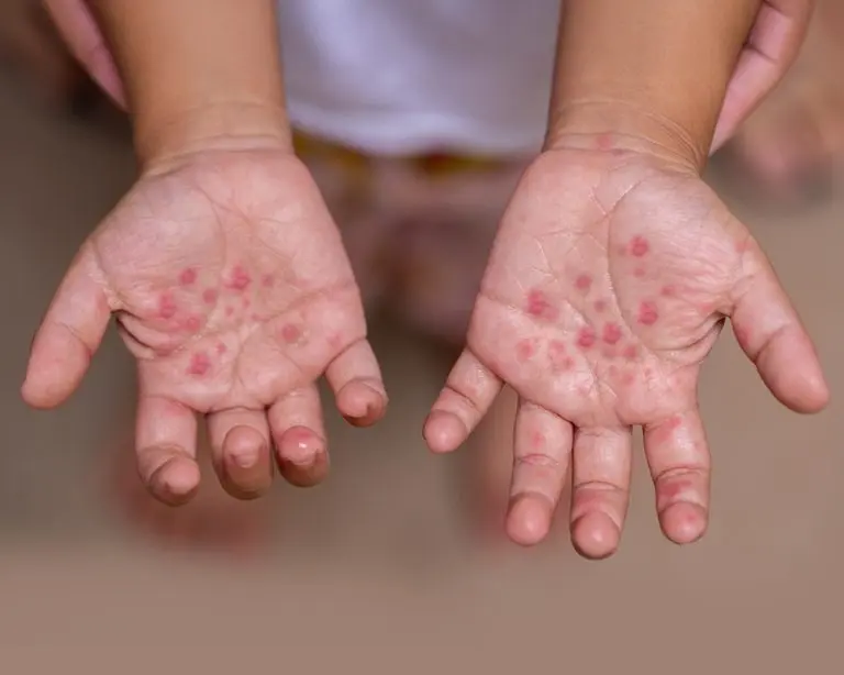 HT6. Skin and Mouth Symptoms You Should Never Ignore: What They Might Be Telling You